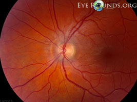 high water marks after optic nerve head edema