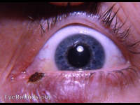 hyfrecated cyst of gland of Moll