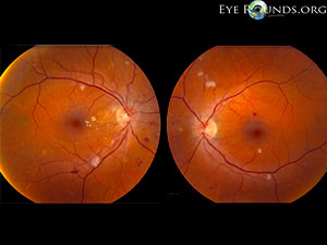 Hypertensive retinopathy