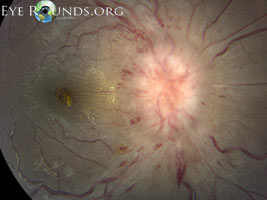 Idiopathic Intracranial Hypertension
