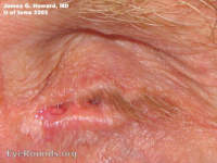 Tarsorrhaphy, permanent