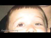 Congenital Ptosis