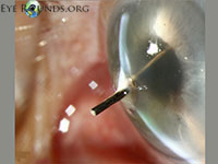 Intraocular foreign body
