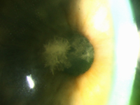 Infectious crystalline keratopathy