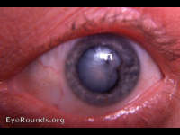 intumescent traumatic cataract