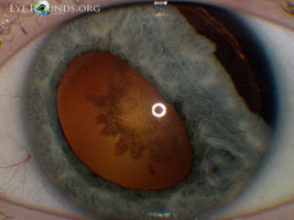 Iridodialysis and traumatic cataract