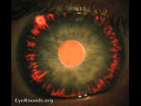 pigment dispersion syndrome / glaucoma