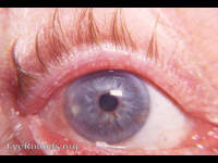 localized nodular keratitis