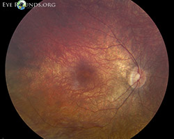 Leber Congenital Amaurosis, RPE65-associated