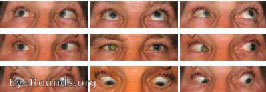 Esotropia