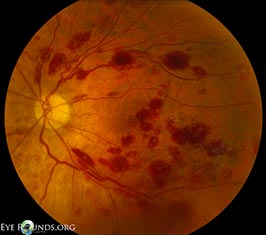 Leukemic retinopathy
