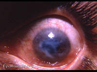 lime burn of the cornea, left eye