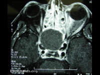 sphenoid sinus mucocele