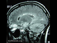 multiple sclerosis