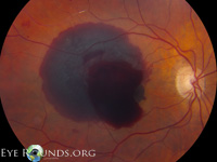 macular heme