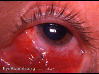 McReynold's procedure for pterygium, post-op