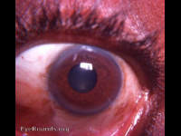 Healed McReynold's pterygium transplantation operation