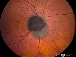 Melanocytoma with associated choroidal nevus