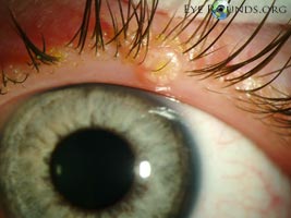 Molluscum contagiosum