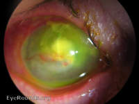 Bacterial Keratitis