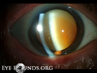 Morgagnian cataract