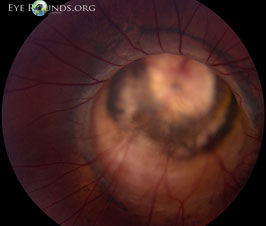 Morning Glory Disc Anomaly with Peripapillary Staphyloma