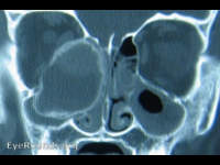 Mucocele
