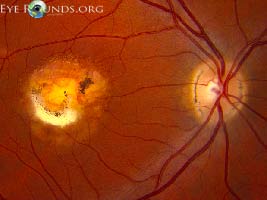 North Carolina macular dystrophy