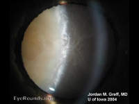 Mature Cataract