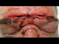nasoethmoidal fracture
