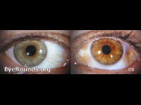 Nevus of Ota