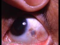 residual plaque of thinned sclera following nodular scleritis
