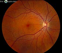 normal fundus normal fundus, adult