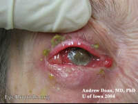 pan-endophthalmitis