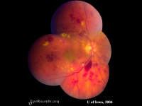 Accelerated Hypertension with hypertensive retinopathy
