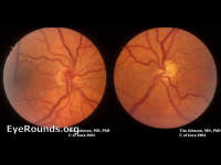 optic nerve hypoplasia