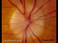 Optic Disc Drusen