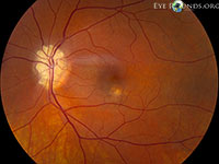 Optic Nerve Drusen