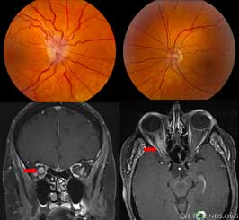 Optic nerve sheath meningioma