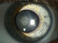 Ocular syphilis