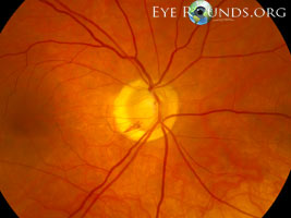Optic Disc hemorrhage