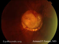 Optic Nerve Coloboma with Optic Pits