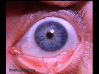 adrenochrome due to epinephrine