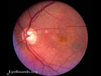 pigment epithelial detachment
