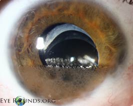 Retained perfluorocarbon liquid in the anterior chamber