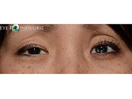 Prostaglandin analog fat atrophy