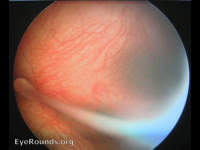 persistent hyperplastic primary vitreous (PHPV)