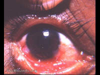 active PKC lesion and a post-PKC pseudopterygium