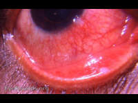 phlyctenular keratoconjunctivitis