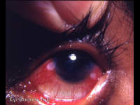 phlyctenular keratoconjunctivitis (PKC)